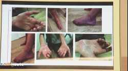 Fatigue-Syndrom, Durchblutungsstörungen: Wie Menschen unter Impfnebenwirkungen leiden